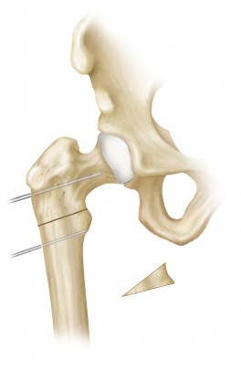 Illustration 10 for Intertrochanteric Femoral Osteotomy: Indications for Hip Preservation