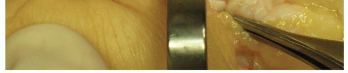 Illustration 22 for Plantar Plate Repair: End Lesser Toe Pain & Instability