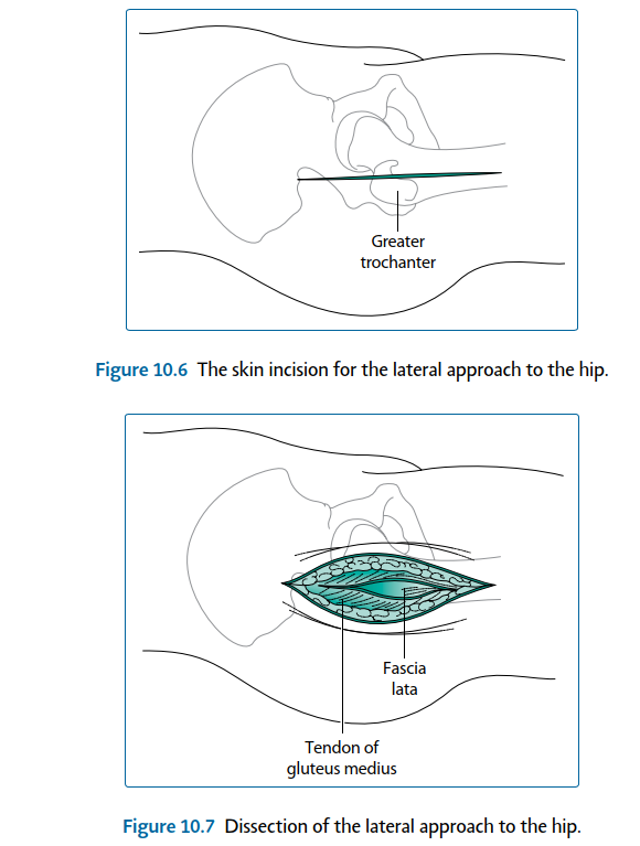 Illustration 28 for Mastering Short External Rotators for Optimal Hip Surgery Results
