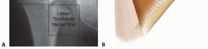 Illustration 3 for Achieve Optimal Femoral Head Fixation with Cephalomedullary Nailing