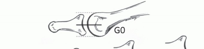 Illustration 4 for Plantar Plate Repair: End Lesser Toe Pain & Instability
