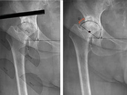 Illustration 4 for Maximize Success: Preoperative planning in primary Hip Replacement