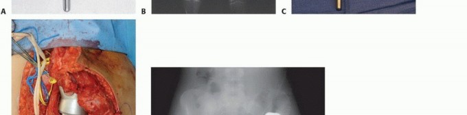 Illustration 10 for Distal Femoral Replacement: Key to Modern Limb Salvage