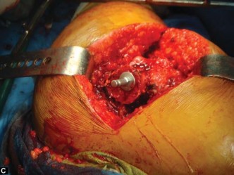 Illustration 49 for The Silent Hip: Achieving a Truly Silent, Pain-Free Joint