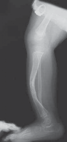 Illustration 7 for Solving Congenital Pseudarthrosis: Tibia with the Williams Rod