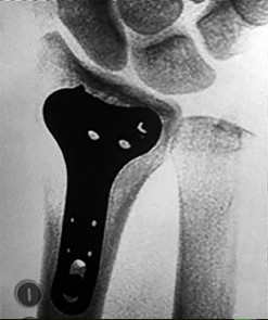 صورة طبية: دليل الأستاذ الدكتور محمد هطيف الشامل لأمراض وإصابات اليد والمعصم في صنعاء