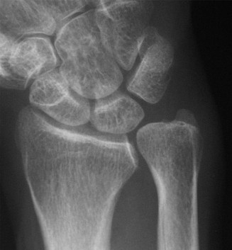 Illustration 8 for Christine M Kleinert Discussion: Solving Difficult Wrist Fractures