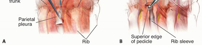 Illustration 2 for Anterior Thoracic Corpectomy: Decompression, Stabilization, Fusion