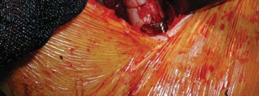 Illustration 60 for S-ROM: Inside the Technique of Modular Implant Design