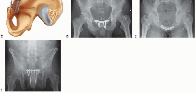 Illustration 22 for Achieve Stable Fixation of the Symphysis: Open Reduction