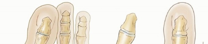 Is Surgical Correction of Juvenile Bunion Right for Your Child?