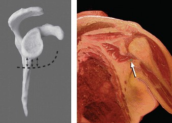 Multidirectional Instability MDI: Spot & Treat Shoulder Instability