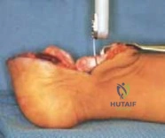 الدليل الشامل لعلاج تشوهات اليد الخلقية عند الأطفال