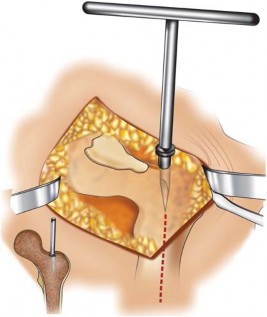 Illustration 4 for Mastering Cementing Technique Femur: A Step-by-Step Guide