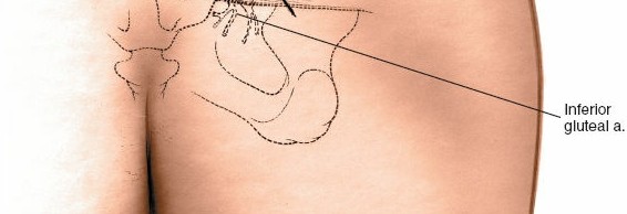 Illustration 35 for Pelvis & Acetabulum Approaches: Unlocking the Posterior Superior Iliac