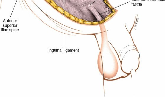 Illustration 7 for Ilioinguinal Approach: Master the Deep Inguinal Ring for Success