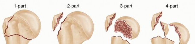 Open Reduction for Humerus Fractures: Your Surgical Guide