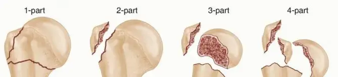 صورة توضيحية لـ كسور الجزء العلوي من عظم العضد: دليل المريض الشامل للتشخيص والعلاج والتعافي تحت إشراف الأستاذ الدكتور محمد هطيف