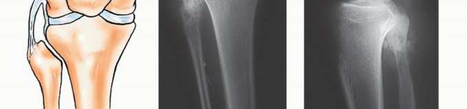 Illustration 11 for Beyond Amputation: The Type I Resection in Fibular Tumor Surgery