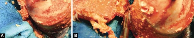 Illustration 85 for Birmingham Hip Resurfacing Designer's Technique for Active Lives