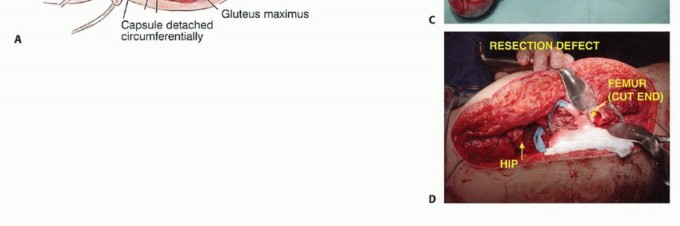 Illustration 30 for Beyond Amputation: Total Femur Resection with Endoprosthetics