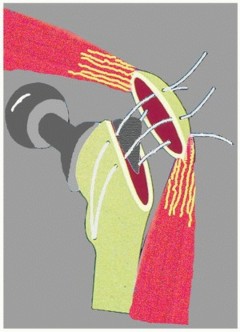 Illustration 34 for Sliding Trochanteric Osteotomy: Modern Role & Refined Techniques