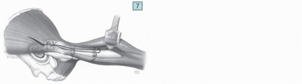 Illustration 12 for Mastering Component Removal: Extended Trochanteric Osteotomy