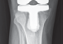 صورة طبية: استبدال مفصل الركبة بالحد الأدنى من التدخل الجراحي: ألم أقل وتعافٍ أسرع مع النهج شبه الرضفي الإنسي