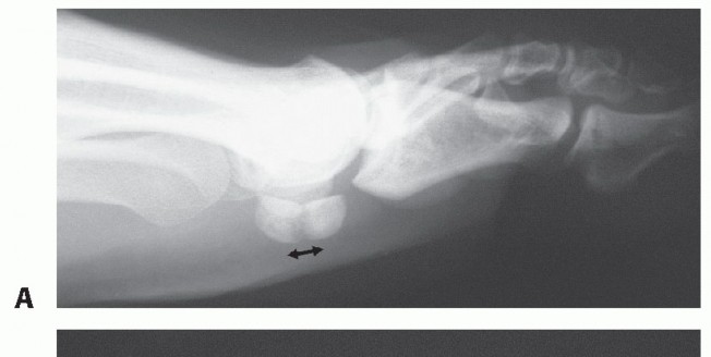 Illustration 5 for Optimizing Internal Fixation of Sesamoid Fractures