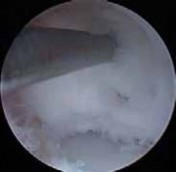 Illustration 46 for Precision Arthroscopy for Chondral Injuries & OCD: Direct Lateral Portal