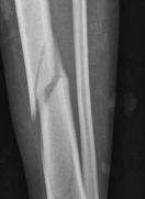 Illustration 2 for Tibial Fracture Extending into the Plafond: Intramedullary Secrets