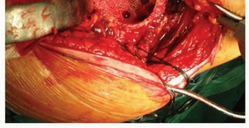 Illustration 17 for Cemented Acetabular Component: Achieving Optimal THA Stability