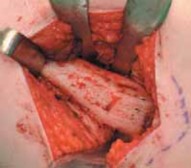 Illustration 10 for Increased Femoral Anteversion: A Proximal Femoral Rotational Osteotomy