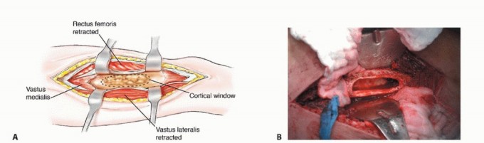 Illustration 26 for Mastering Femoral Metastases: Optimal Function for Femoris & Vastus