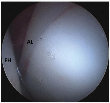Illustration 15 for Beyond Knee Surg: Hip Arthroscopy for Sports Injuries