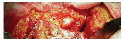 Illustration 13 for Cemented Total Hip: A Successful & Evidence-Based Solution