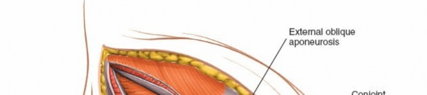 Illustration 11 for Ilioinguinal Approach: Master the Deep Inguinal Ring for Success