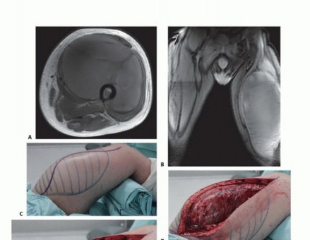 Illustration 24 for Limb-Sparing Quadriceps Resection: Superficial Femoral Artery