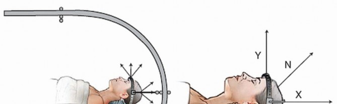 Illustration 3 for Master Techniques for Cervical Fracture Reduction: Type III & More