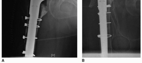 Illustration 22 for Extended Trochanteric Osteotomy: How et al Extended Revision THA Solutions