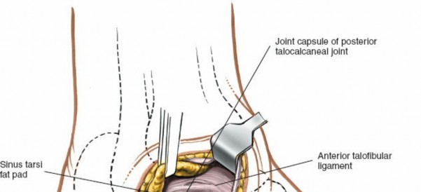 Illustration 110 for Optimized Approaches to the Dorsum of the Foot & Ankle