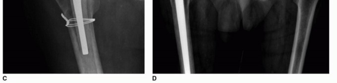 Illustration 12 for PJI of the Hip: Two-Stage Revision: When & How to Prepare