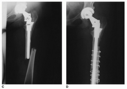 Illustration 29 for Recreate Hip Biomechanics: Modular Stems for Modular Solutions