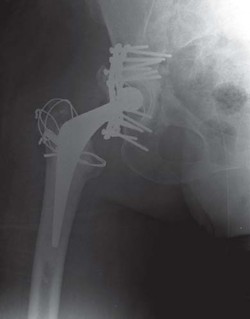 Illustration 5 for Management of Periprosthetic Fractures: An Expert Surgical Guide