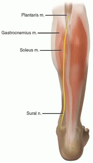 صورة توضيحية لـ تمزق وتر أخيل: دليل شامل للمرضى نحو الشفاء التام في اليمن والخليج