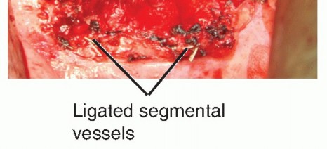 Illustration 6 for Anterior Thoracic Corpectomy: Decompression, Stabilization, Fusion