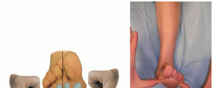 Medial Cuneiform Osteotomy: Key to Correcting Fixed Forefoot Varus