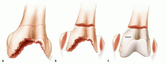 Illustration 8 for Optimizing Revision Femoral Component with Distal Femoral Bone Loss