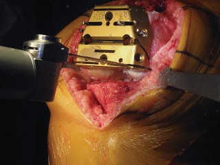 Illustration 31 for Posterior Stabilized Technique: Essential Insights for TKA Success