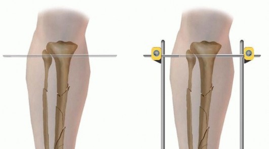 Illustration 48 for Tibia External Fixation: See How Pins Are Placed for Healing